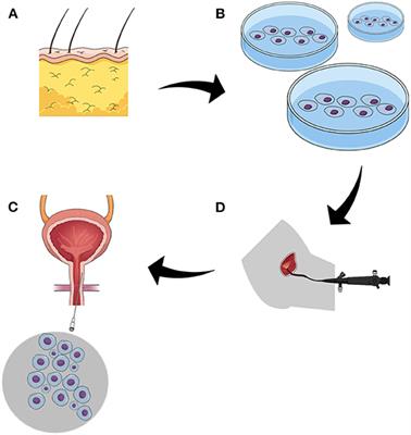 Tissue Engineering and Its Potential to Reduce Prostate Cancer Treatment Sequelae—Narrative Review